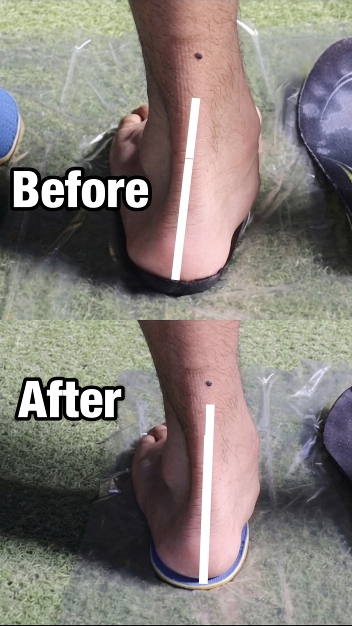 Before インソール使用前